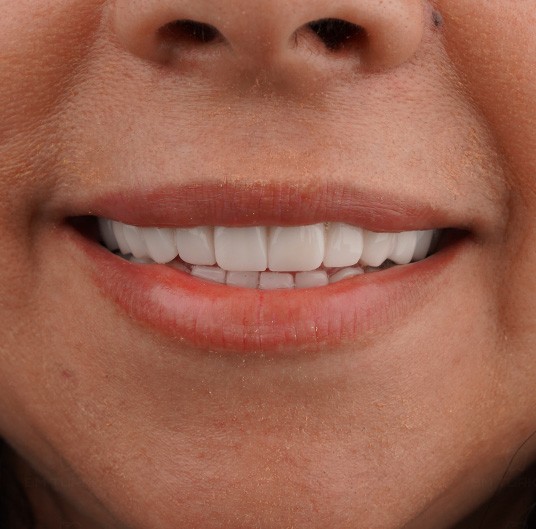 After treatment