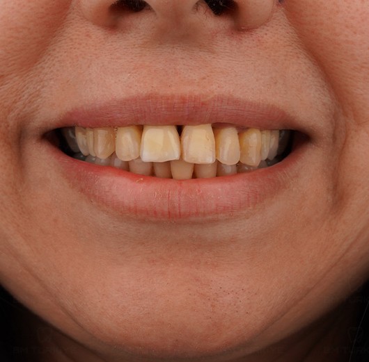 Before treatment